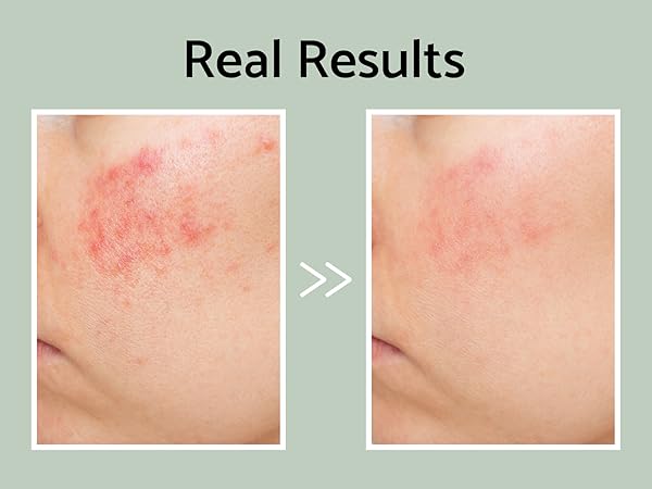 ژل ضدجوش فوری آیونیک 